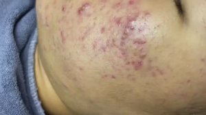 011 • Relax Spa • АСМР • Acne collection