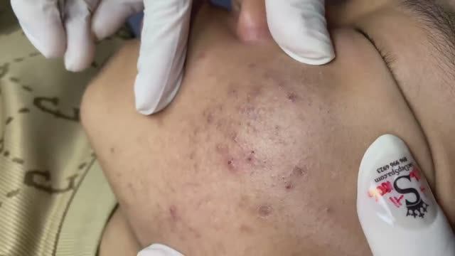 013 • Relax Spa • АСМР • Acne collection