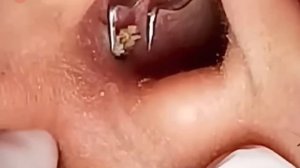 #178 Чистка лица от угрей и акне. Выдавливание прыщей. Удаление черных точек и комедонов