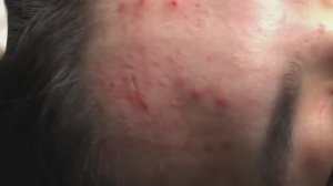 Очищение кожи от угревой сыпи и излишков кожного сала.