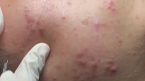 Профессиональное удаление угрей