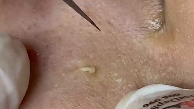 Выдавливание прыщей, угрей, черных точек и камедонов #273