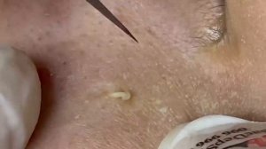 Выдавливание прыщей, угрей, черных точек и камедонов #273