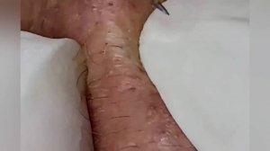 Выдавливание прыщей, угрей, черных точек и камедонов #272