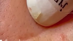 #177 Чистка лица от угрей и акне. Выдавливание прыщей. Удаление черных точек и комедонов