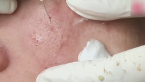 Лечение скрытых прыщей (закрытых комедонов) HHV