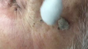 Кератомы на коже лица. Криодеструкция