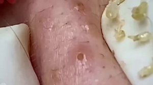 #179 Чистка лица от угрей и акне. Выдавливание прыщей. Удаление черных точек и комедонов