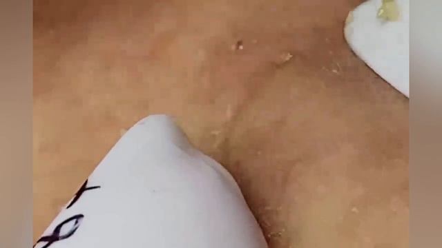 Выдавливание прыщей, угрей, черных точек и камедонов #276