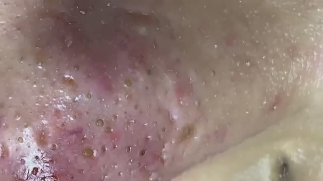 Выдавливание прыщей и подкожных угрей.#887561 Asmr.