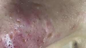 Выдавливание прыщей и подкожных угрей.#887561 Asmr.