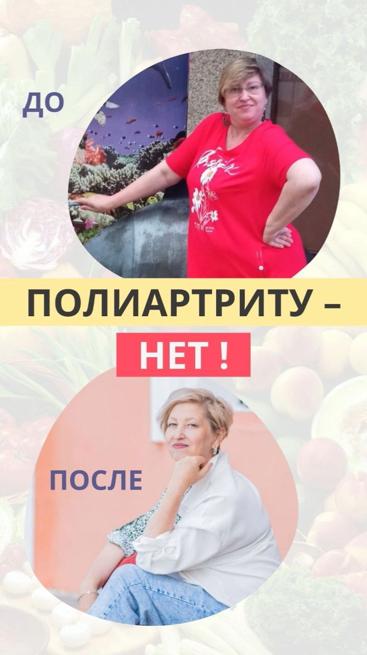 Полиартриту - НЕТ