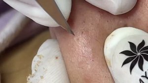 Механическое очищение пор от прыщей и белых точек #28