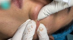 Asmr. Чистка лица от акне. #57