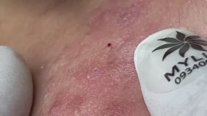 Механическое очищение пор от прыщей и белых точек #32 Часть 2