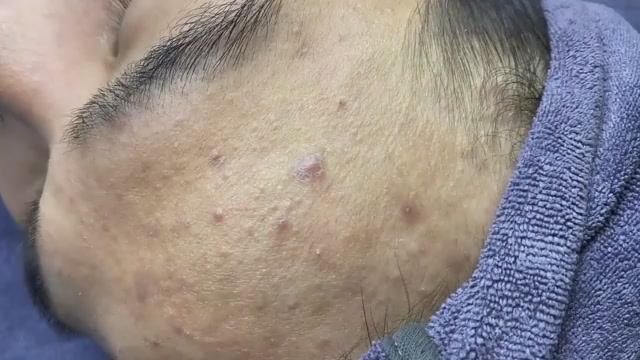 022 • Relax Spa • АСМР • Acne collection