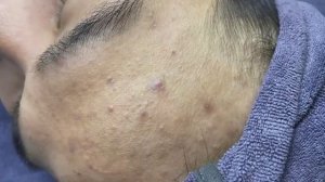 022 • Relax Spa • АСМР • Acne collection