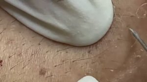 Очищение кожи от черных точек и сальных пробок. 2180