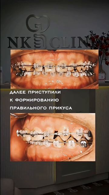 Результат лечения синдрома Игла-Стерлинга