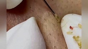 Выдавливание прыщей, угрей, черных точек и камедонов #280