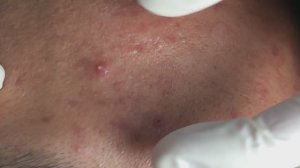 Избавление от угревой сыпи на лице. Часть 2