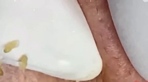 #183 Чистка лица от угрей и акне. Выдавливание прыщей. Удаление черных точек и комедонов