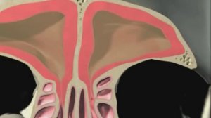 Баллонная синусопластика