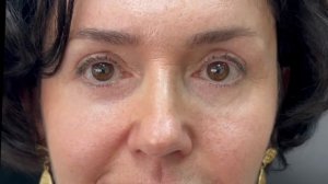 1 год после операции эндоскопический лифтинг лба  висков плюс нижняя блефаропластика