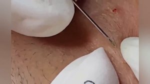 Выдавливание прыщей, угрей, черных точек и камедонов #279