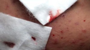 Избавление от угревой сыпи на лице. Часть 1