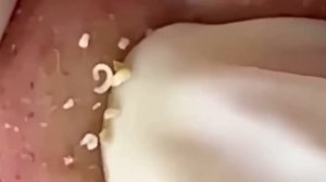 #182 Чистка лица от угрей и акне. Выдавливание прыщей. Удаление черных точек и комедонов