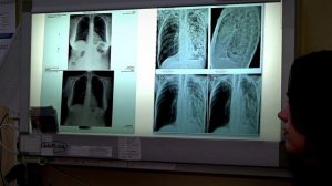 Жителей Твери приглашают на бесплатное флюорографическое обследование в рамках акции "Просветись"