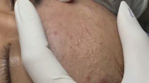 Чистим лицо от прыщей и черных точек. Расслабляющий видеоролик.