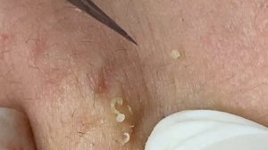 ЛЕЧЕНИЕ АКНЕ удовлетворение и релакс в одном флаконе....