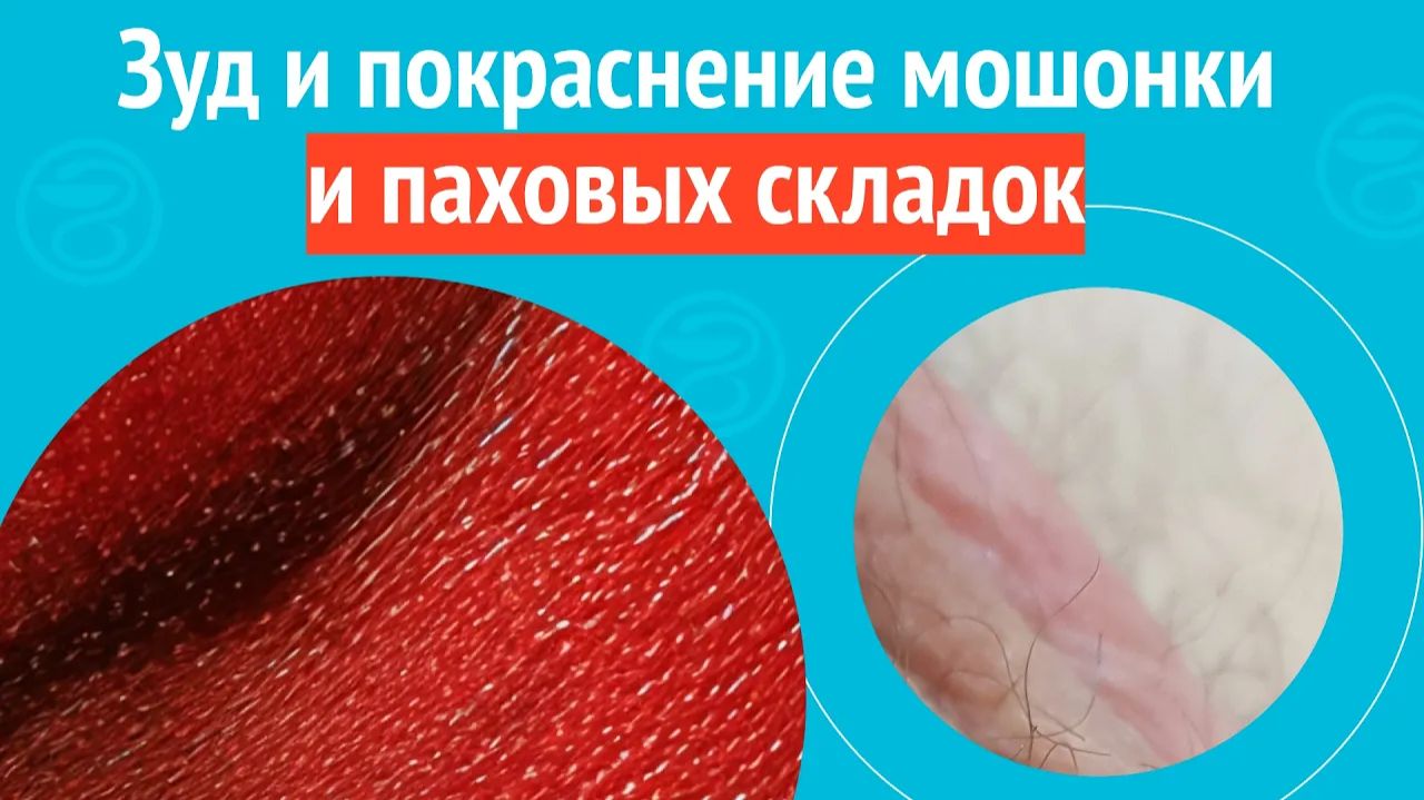 🙁 Зуд и покраснение мошонки и паховых складок. Клинический случай № 1759 смотреть онлайн