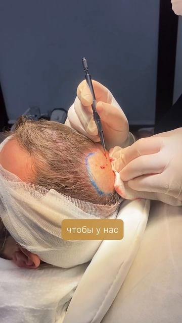 Пересадка волос — комфортная процедура без боли и стресса в клинике INNOVACIA смотреть онлайн