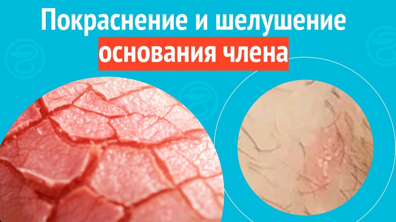 ↪️ Покраснение и шелушение основания члена. Клинический случай № 1757 смотреть онлайн