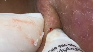 Выдавливание прыщей, угрей, черных точек и камедонов #282