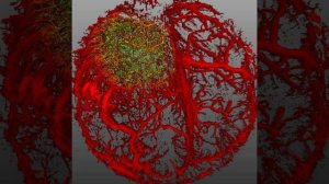 Глиобластома