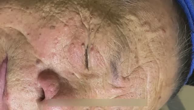 Удаление прыщей у деда в 90 лет: полный процесс. Часть 1