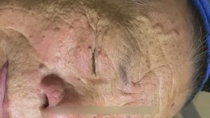 Удаление прыщей у деда в 90 лет: полный процесс. Часть 1