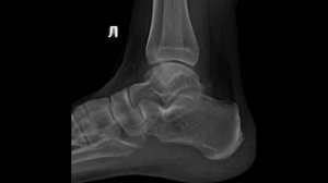 укладка голеностопного сустава