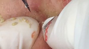 Выдавливание прыщей, угрей, черных точек и камедонов #283