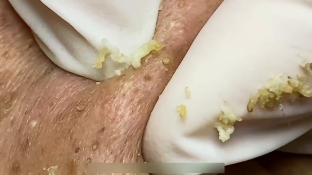 Удаление прыщей у деда в 90 лет: полный процесс. Часть 2