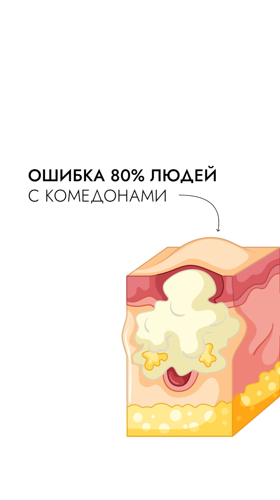 Главная ошибка 80% людей с комедонами