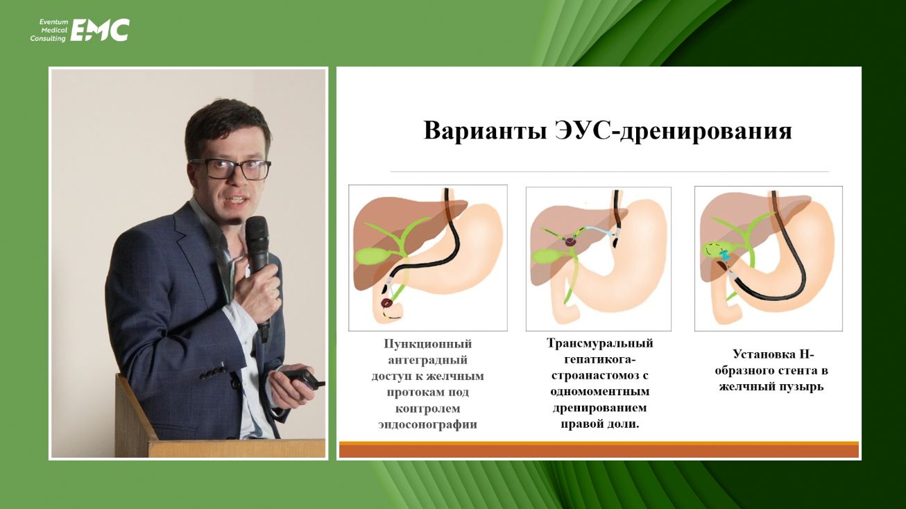 6. Русанов Д.С, Бурдюков М.С. Мультицентровое исследование методик ЭУС-дренирования желчных протоков
