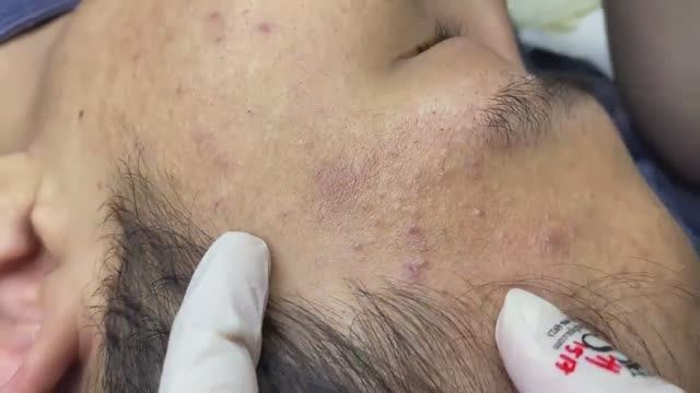 023 • Relax Spa • АСМР • Acne collection