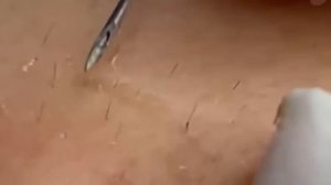 #186 Чистка лица от угрей и акне. Выдавливание прыщей. Удаление черных точек и комедонов