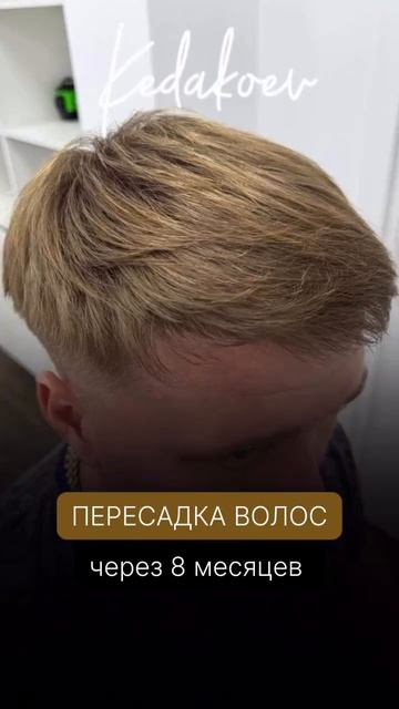 Результат пересадки волос спустя 8 месяцев🔥 смотреть онлайн