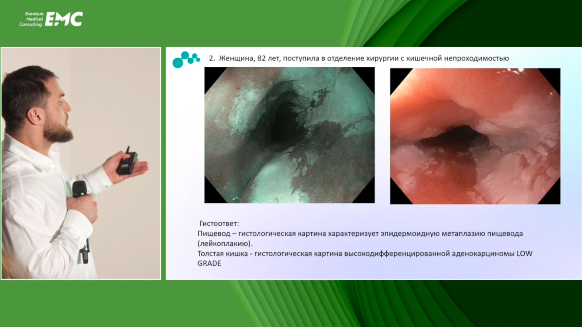 3. Хайрулаев А.М. Лейкоплакия пищевода - эндоскопическая диагностика и тактика ведения пациентов.
